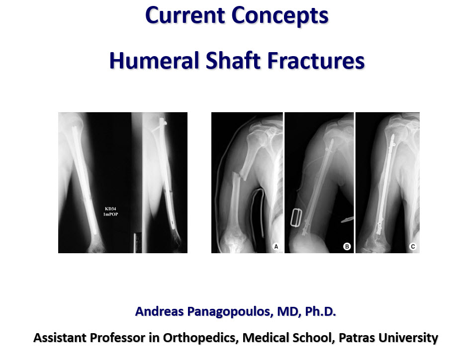 Humeral shaft fractures