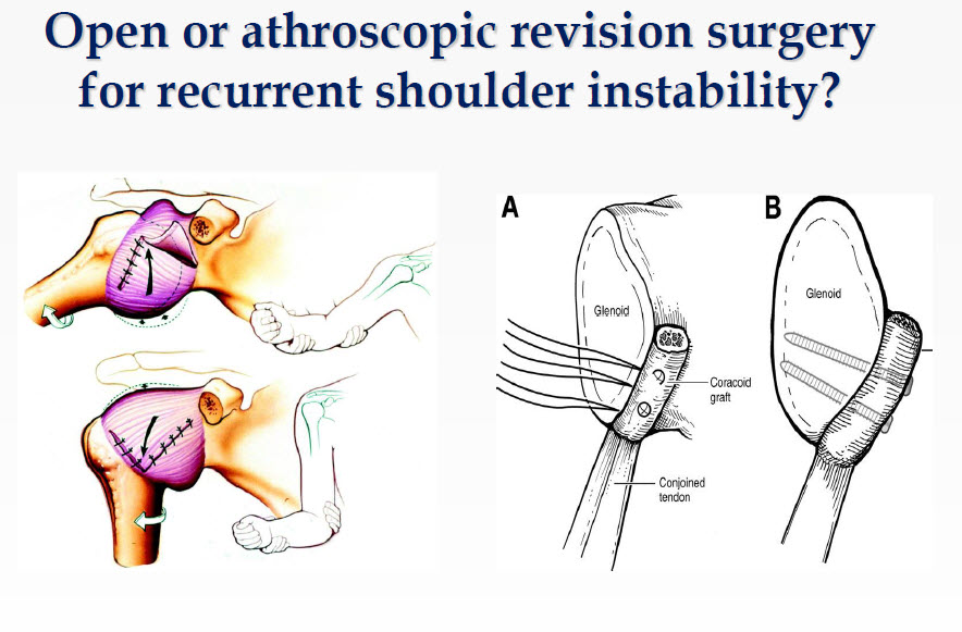 Open or athroscopic revision surgery for shoulder instability